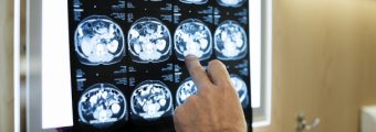 Zdjęcie rentgenowskie z tomografii komputerowej mózgu. Fot. serwis Rawpixel