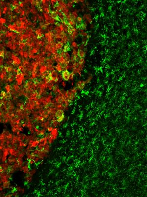 Obraz mikroskopowy przekroju mózgu mysiego z glejakiem. Fot.: dr hab. Anna Malik